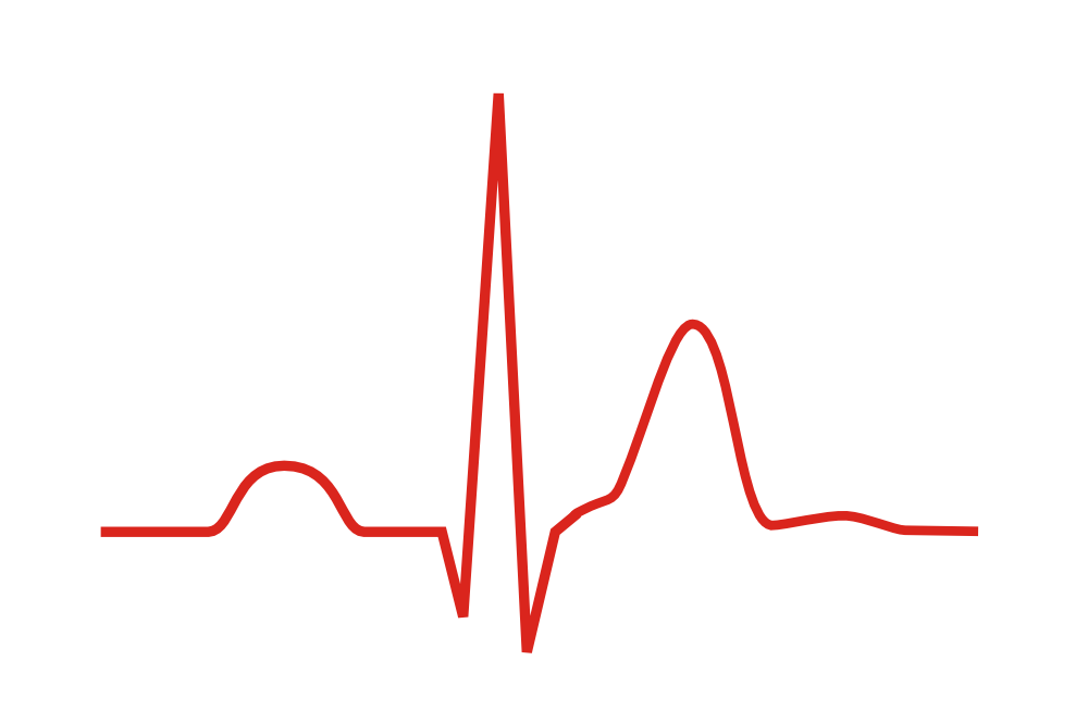 Une onde ECG montrant un raccourcissement de l'intervalle QT.